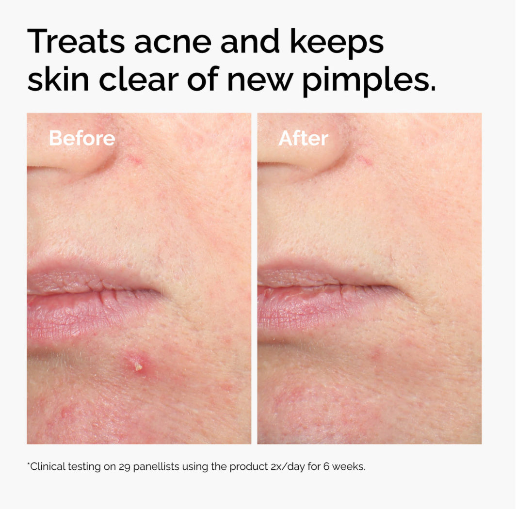 The Ordinary Salicylic Acid 2% Solution / Tratamiento Ácido Salicílico para Acné 30ml